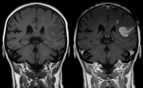 MRI contrast vs no contrast