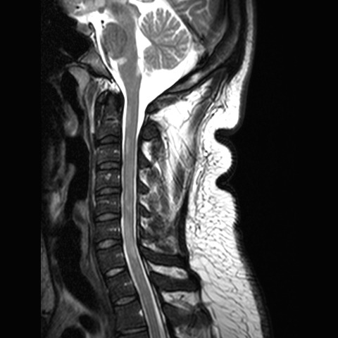 multiple sclerosis and MRI